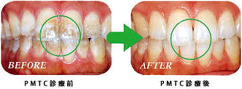 予防歯科・クリーニング_before-after五反田エヌエイ歯科